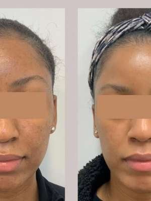 Chemical Peel